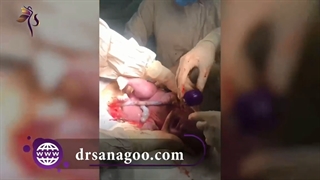 زایمان سزارین