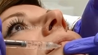لبهای خوش فرم با تزریق ژل