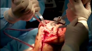 تعویض-مفصل-زانو