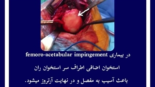 بیماری فمور و استابولار