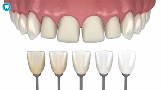 لمینت دندان چگونه انجام می شود