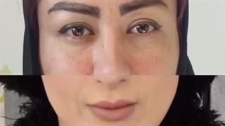دکتر سروش کافی جراح پلک لیپوست