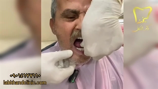 ثبات دندان مصنوعی با ایمپلنت