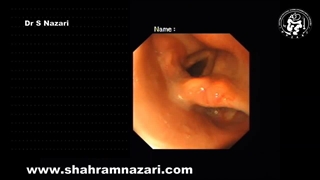 آندوسکوپی و نشانه های آشالازی مری