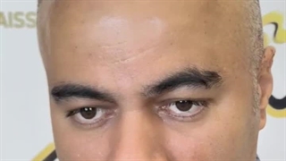 کاشت موی طبیعی بدون جراحی در کلینیک زیبایی رنسانس