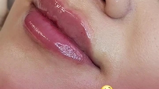 تزریق فیلر لب