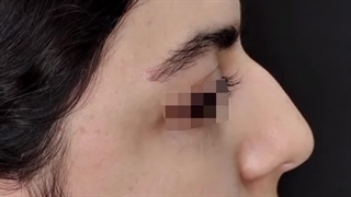 بلافاصله پس از جراحی بینی جدید