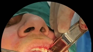 ایمپلنت دندان در تهران توسط دکتر حمید پورصادقی