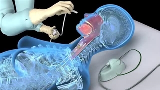 نازوتراکیال چیست؟